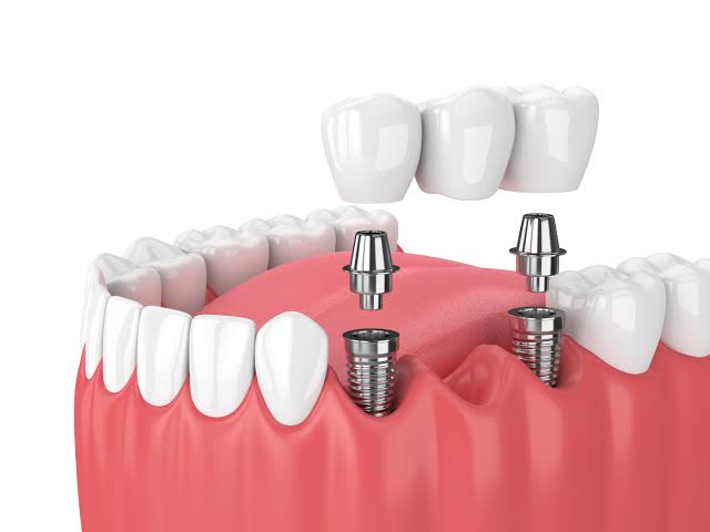 Complete guide to dental implants in Kenya